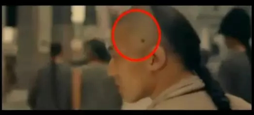 皮肤癌发病率逐年增高，在家自检六步走