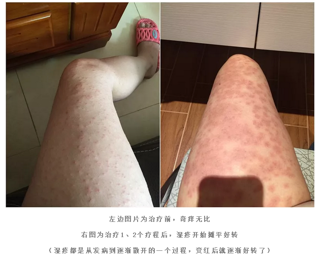 怀孕7月招来“湿疹”大魔王，一根银针巧“拆弹”
